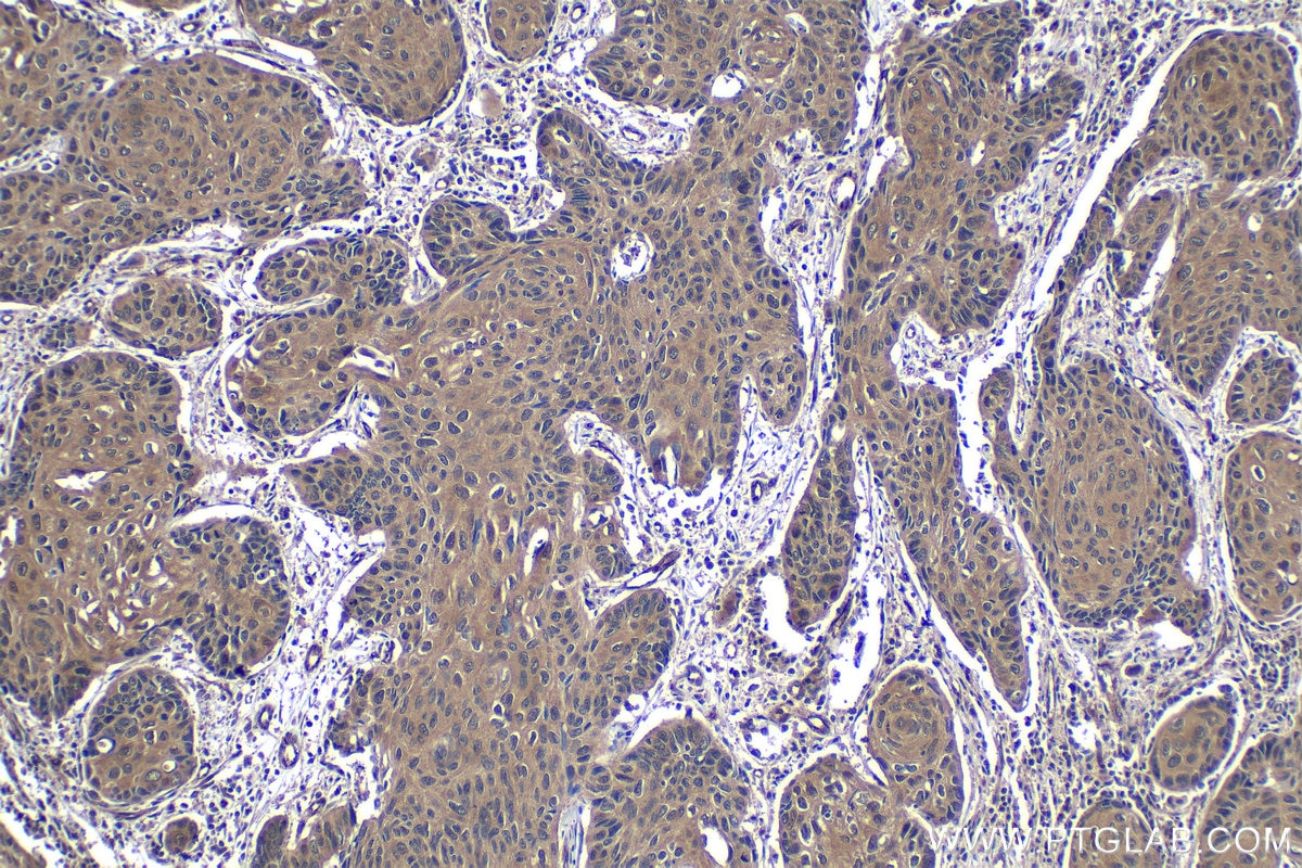 Immunohistochemical analysis of paraffin-embedded human lung cancer tissue slide using KHC1251 (FADD IHC Kit).