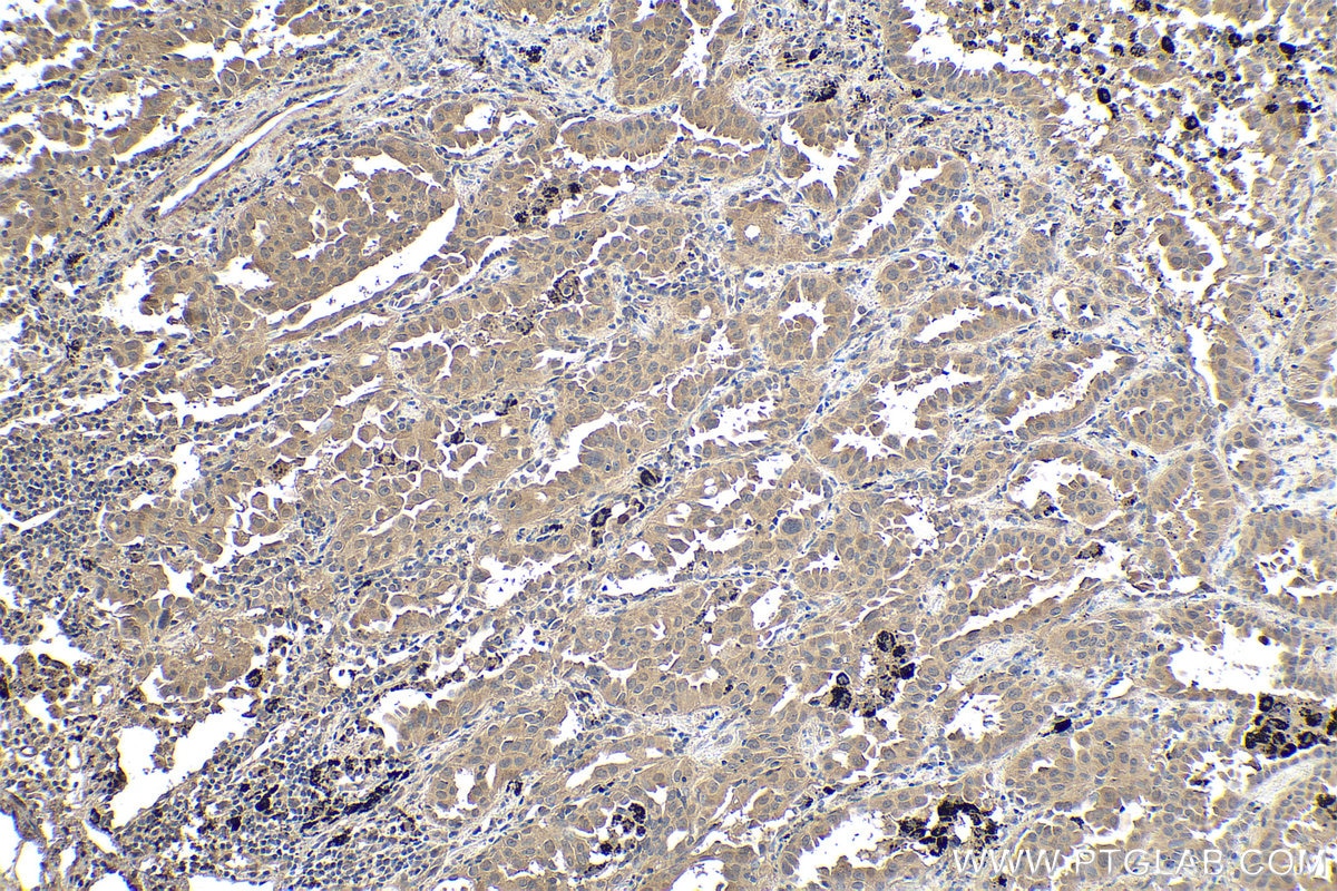 Immunohistochemical analysis of paraffin-embedded human lung cancer tissue slide using KHC0107 (FAK IHC Kit).