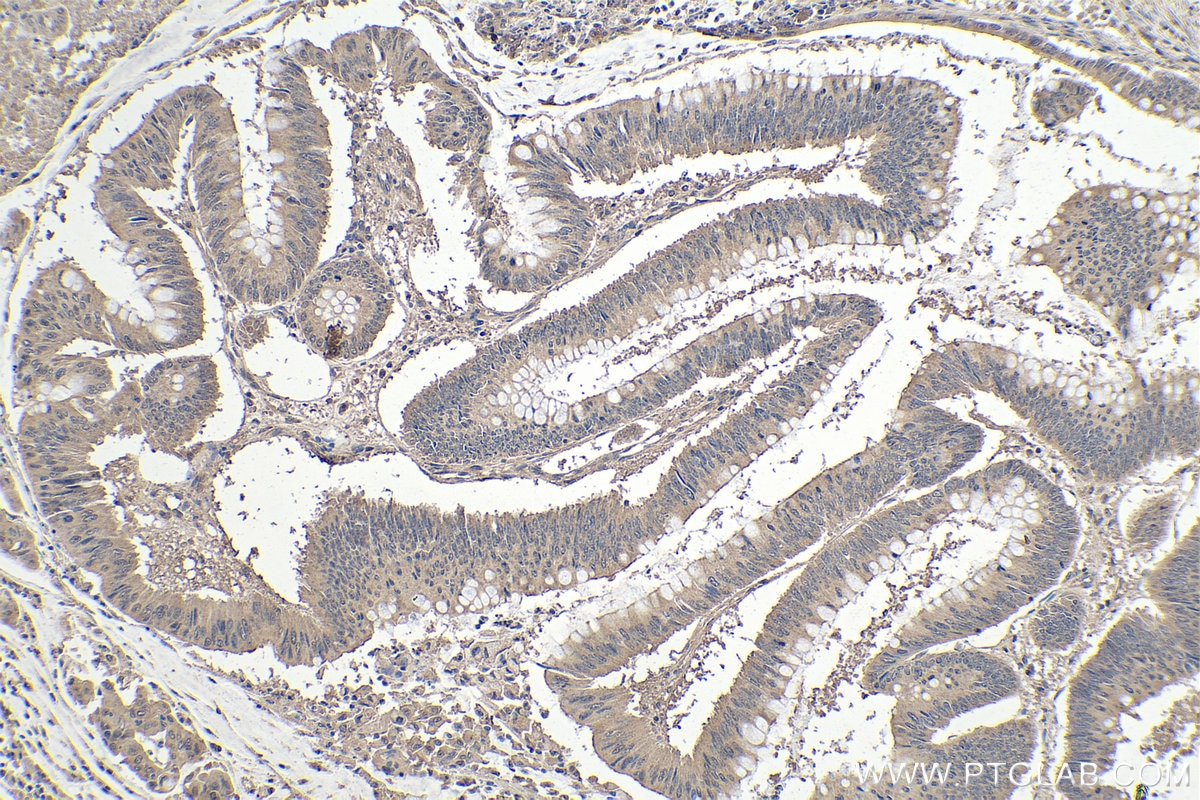 Immunohistochemical analysis of paraffin-embedded human colon cancer tissue slide using KHC0107 (FAK IHC Kit).