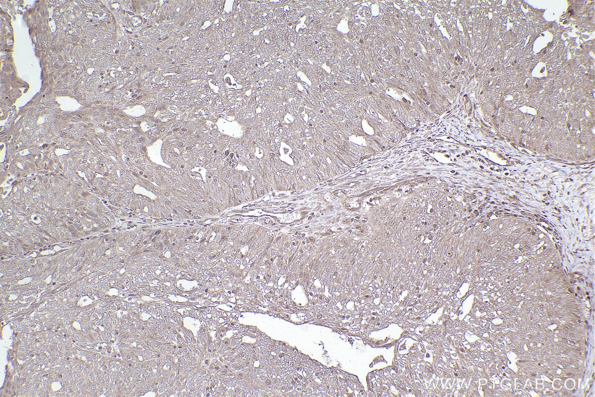 Immunohistochemical analysis of paraffin-embedded human ovary cancer tissue slide using KHC2477 (FAM175B IHC Kit).