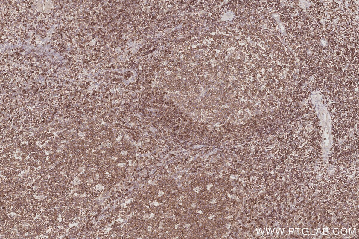 Immunohistochemical analysis of paraffin-embedded human tonsillitis tissue slide using KHC3073 (FAM65B IHC Kit). Immunohistochemical analysis of paraffin-embedded human tonsillitis tissue slide using KHC3073 (FAM65B IHC Kit).