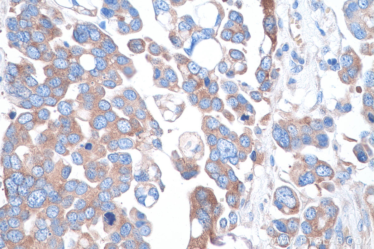 Immunohistochemical analysis of paraffin-embedded human colon cancer tissue slide using KHC0886 (FARSA IHC Kit).