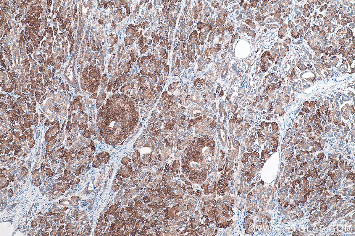 Immunohistochemical analysis of paraffin-embedded human pancreas cancer tissue slide using KHC0886 (FARSA IHC Kit).