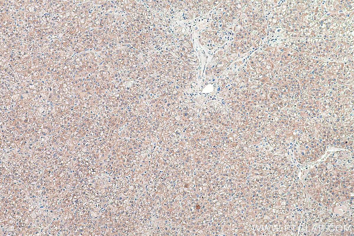 Immunohistochemical analysis of paraffin-embedded human liver cancer tissue slide using KHC0416 (FARSB IHC Kit).