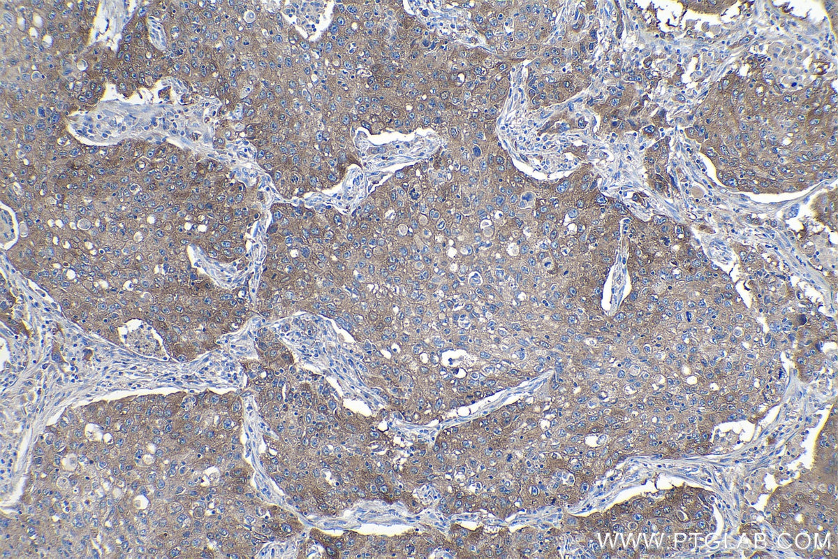 Immunohistochemical analysis of paraffin-embedded human lung cancer tissue slide using KHC1103 (FASN IHC Kit).