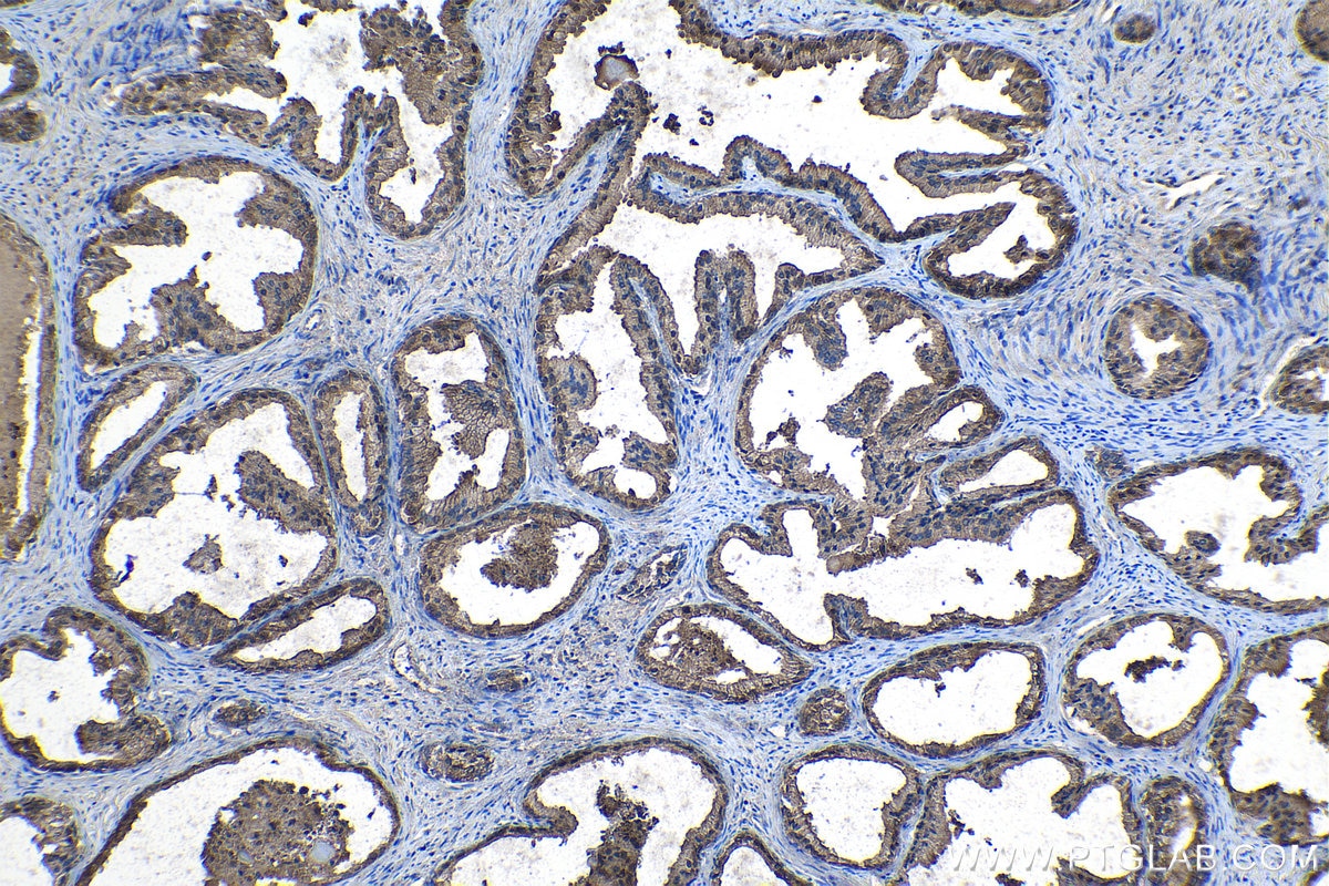 Immunohistochemical analysis of paraffin-embedded human prostate cancer tissue slide using KHC1103 (FASN IHC Kit).