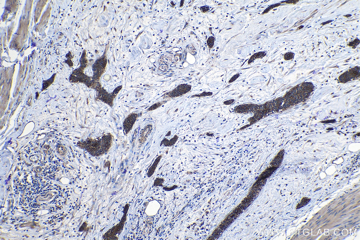 Immunohistochemical analysis of paraffin-embedded human urothelial carcinoma tissue slide using KHC1103 (FASN IHC Kit).