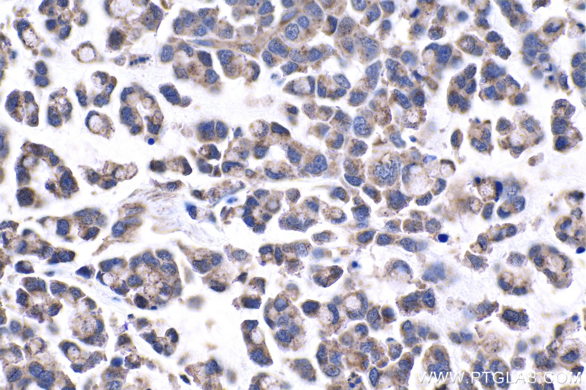 Immunohistochemical analysis of paraffin-embedded human colon cancer tissue slide using KHC1008 (FAU IHC Kit).