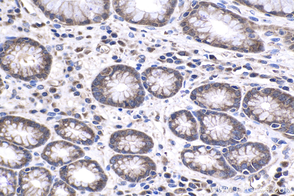 Immunohistochemical analysis of paraffin-embedded human stomach cancer tissue slide using KHC1008 (FAU IHC Kit).