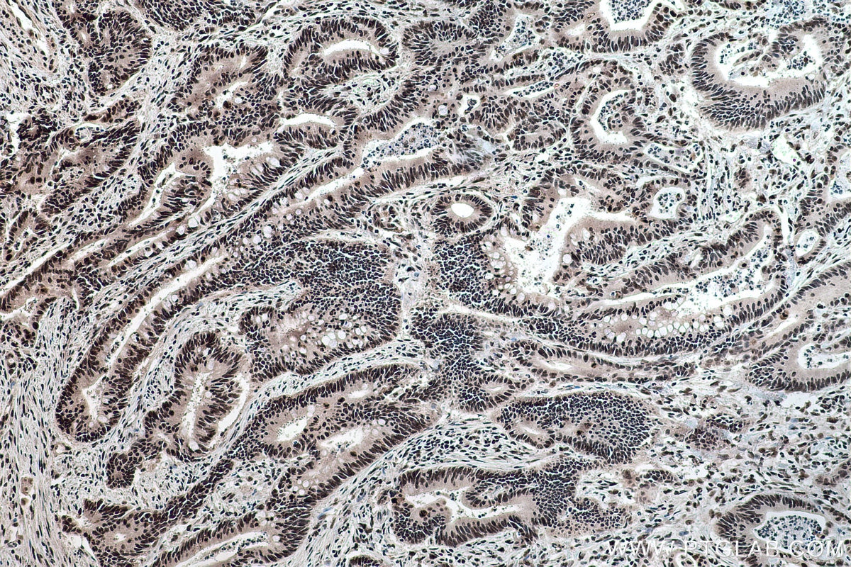 Immunohistochemical analysis of paraffin-embedded human colon cancer tissue slide using KHC0182 (FBL IHC Kit).