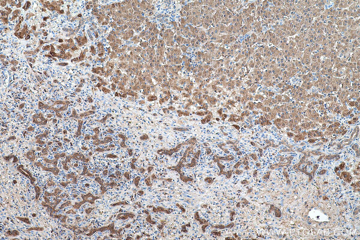 Immunohistochemical analysis of paraffin-embedded human liver cancer tissue slide using KHC0526 (FBP1 IHC Kit).