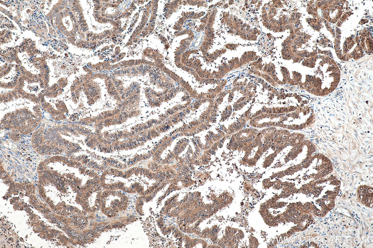 Immunohistochemical analysis of paraffin-embedded human ovary tumor tissue slide using KHC0526 (FBP1 IHC Kit).