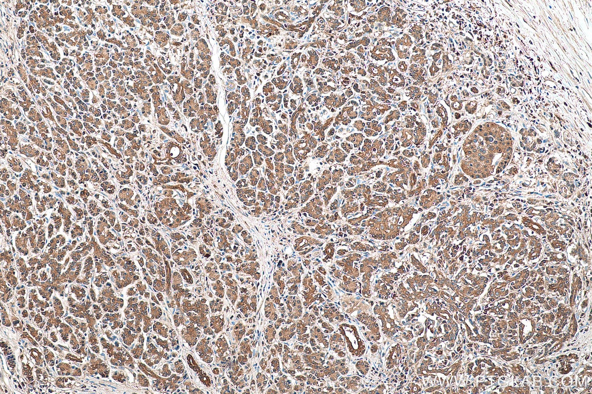 Immunohistochemical analysis of paraffin-embedded human pancreas cancer tissue slide using KHC0526 (FBP1 IHC Kit).