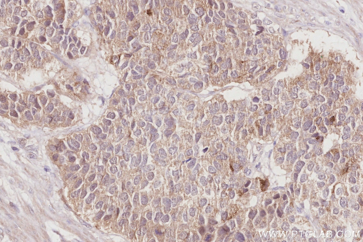 Immunohistochemical analysis of paraffin-embedded human stomach cancer tissue slide using KHC2915 (FBXL15 IHC Kit).