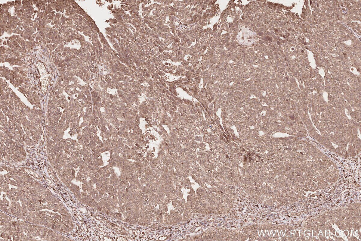Immunohistochemical analysis of paraffin-embedded human ovary cancer tissue slide using KHC2567 (FBXO31 IHC Kit).
