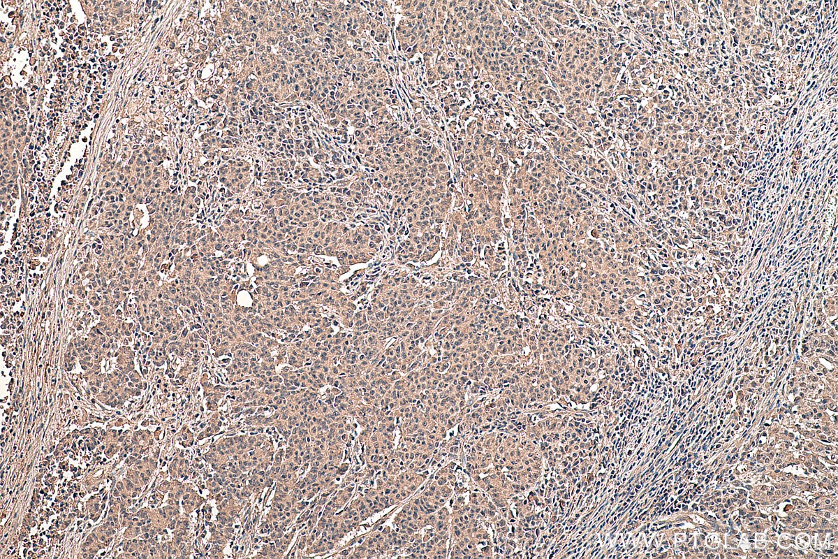 Immunohistochemical analysis of paraffin-embedded human stomach cancer tissue slide using KHC0329 (FBXO32 IHC Kit).