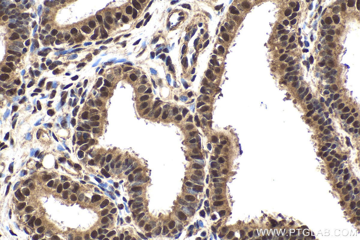 Immunohistochemical analysis of paraffin-embedded human ovary tumor tissue slide using KHC1994 (FBXO5 IHC Kit).