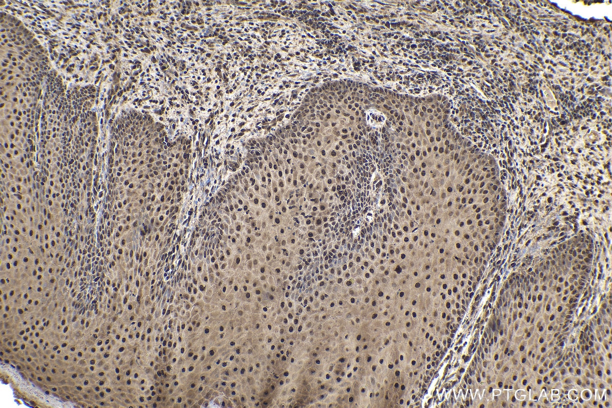 Immunohistochemical analysis of paraffin-embedded human skin cancer tissue slide using KHC1994 (FBXO5 IHC Kit).