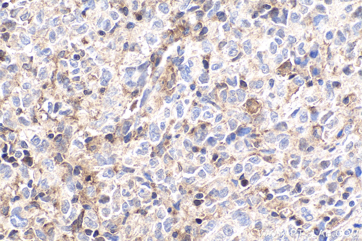 Immunohistochemical analysis of paraffin-embedded human malignant melanoma tissue slide using KHC1872 (FBXW7 IHC Kit).