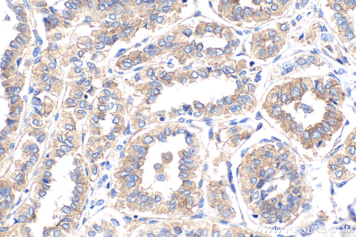 Immunohistochemical analysis of paraffin-embedded human thyroid cancer tissue slide using KHC1872 (FBXW7 IHC Kit).
