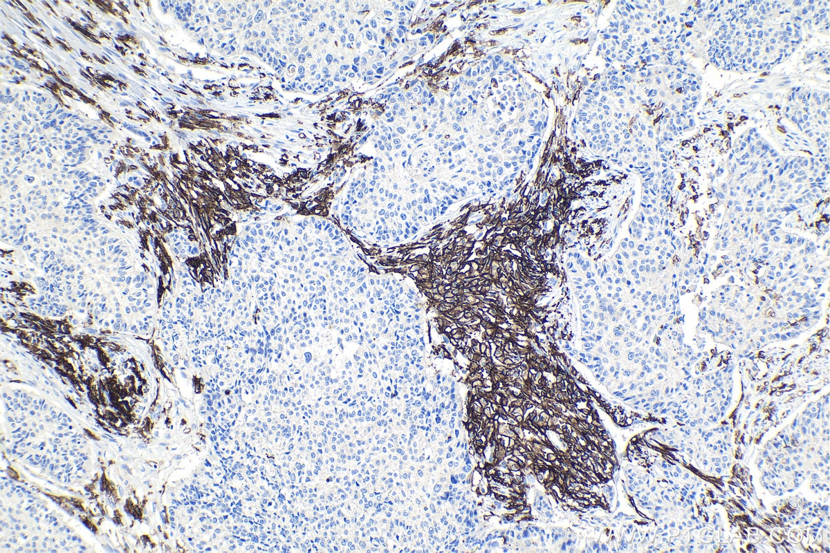 Immunohistochemical analysis of paraffin-embedded human lung cancer tissue slide using KHC0941 (FCGR2A/CD32A IHC Kit).
