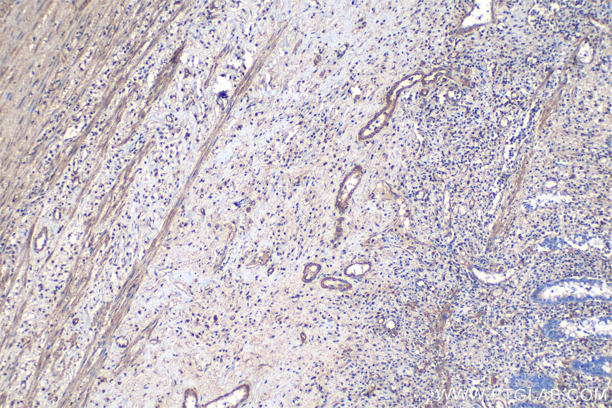 Immunohistochemical analysis of paraffin-embedded human appendicitis tissue slide using KHC1163 (FCGR2B IHC Kit).