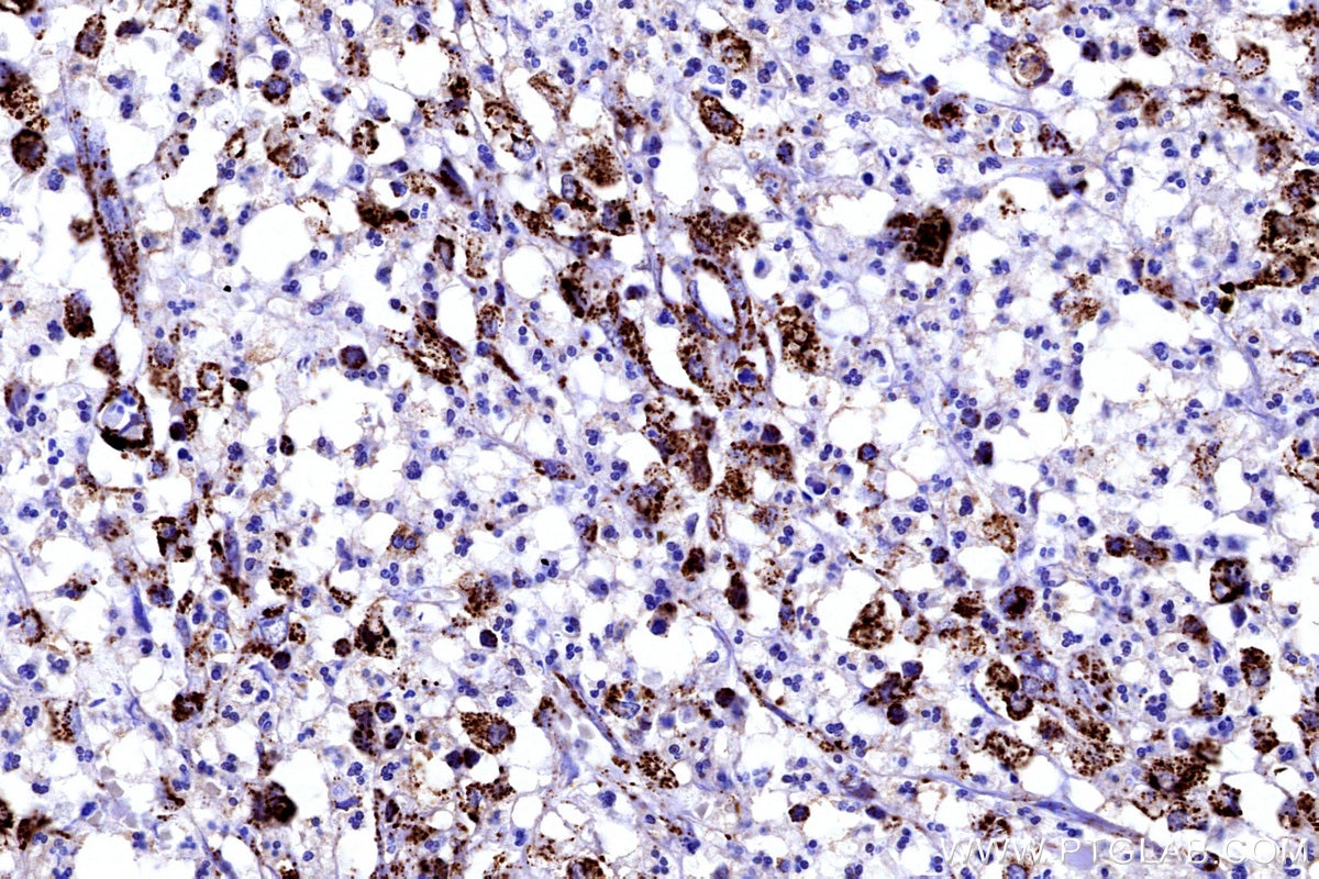 Immunohistochemical analysis of paraffin-embedded human colon cancer tissue slide using KHC3175 (FDX1 IHC Kit).
