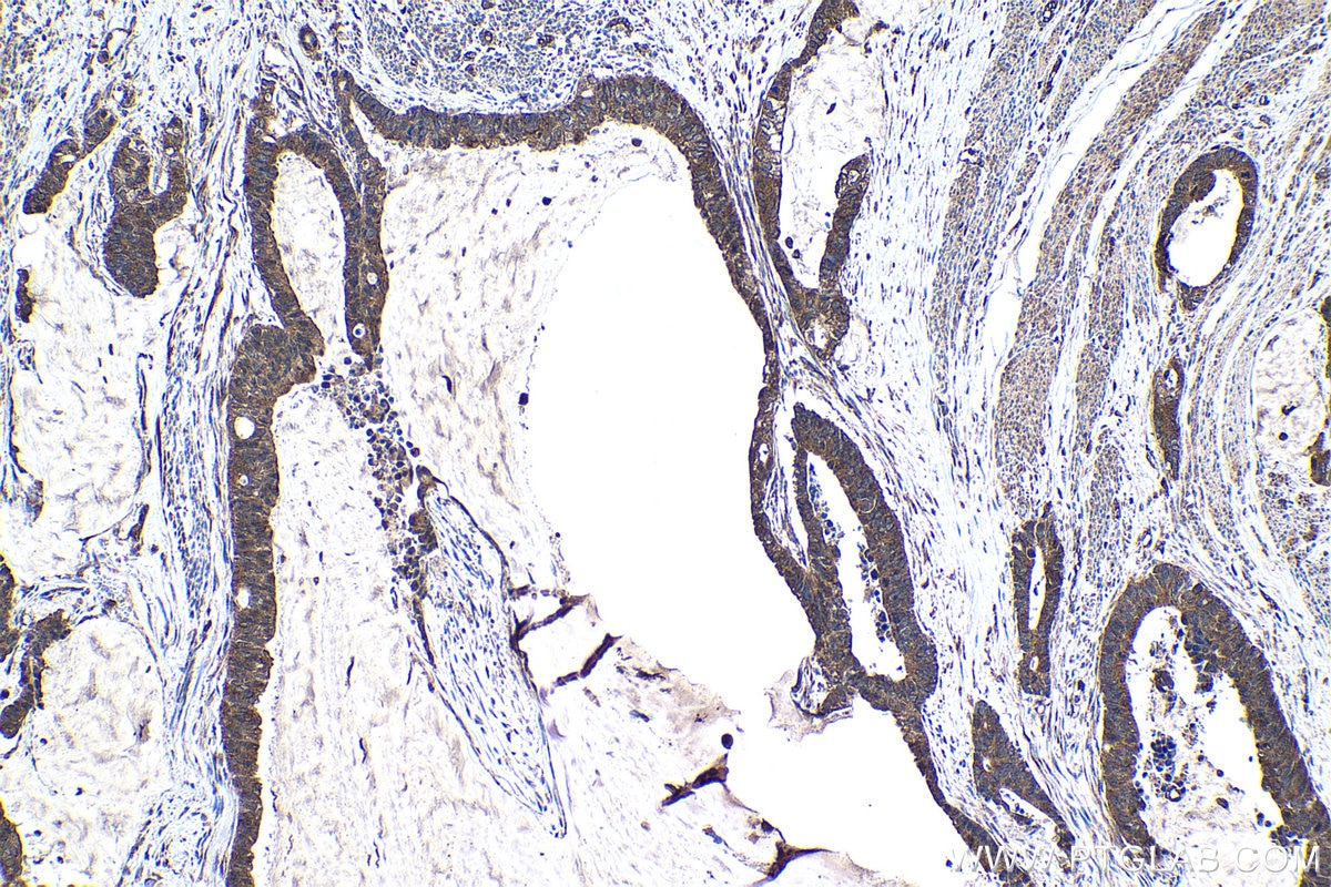 Immunohistochemical analysis of paraffin-embedded human urothelial carcinoma tissue slide using KHC1538 (FER IHC Kit).