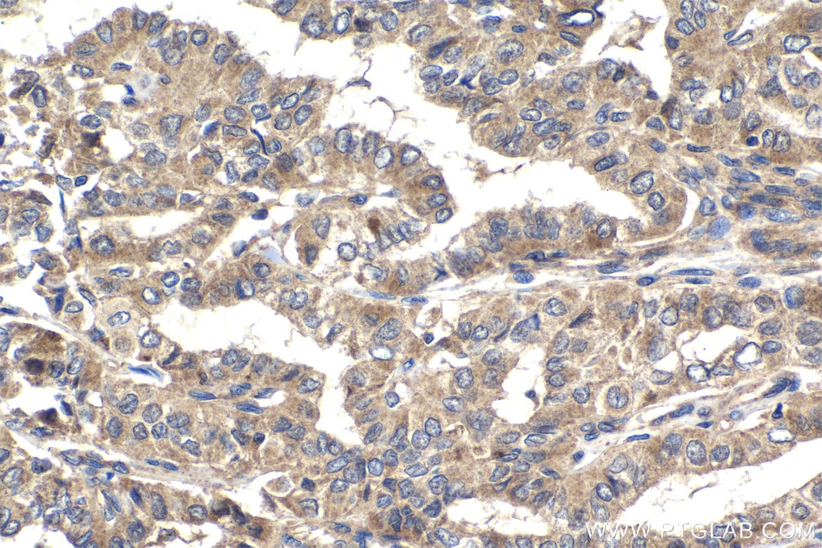 Immunohistochemical analysis of paraffin-embedded human thyroid cancer tissue slide using KHC1538 (FER IHC Kit).