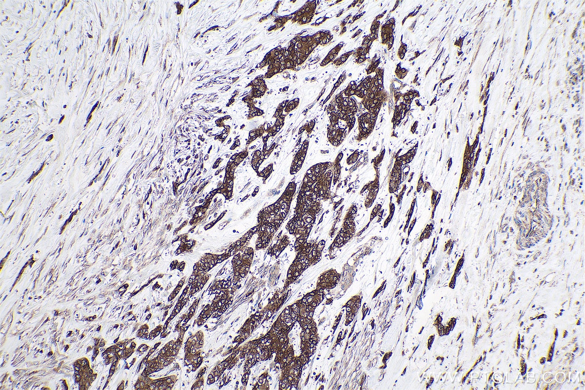 Immunohistochemical analysis of paraffin-embedded human urothelial carcinoma tissue slide using KHC0775 (FERMT1/Kindlin 1 IHC Kit).