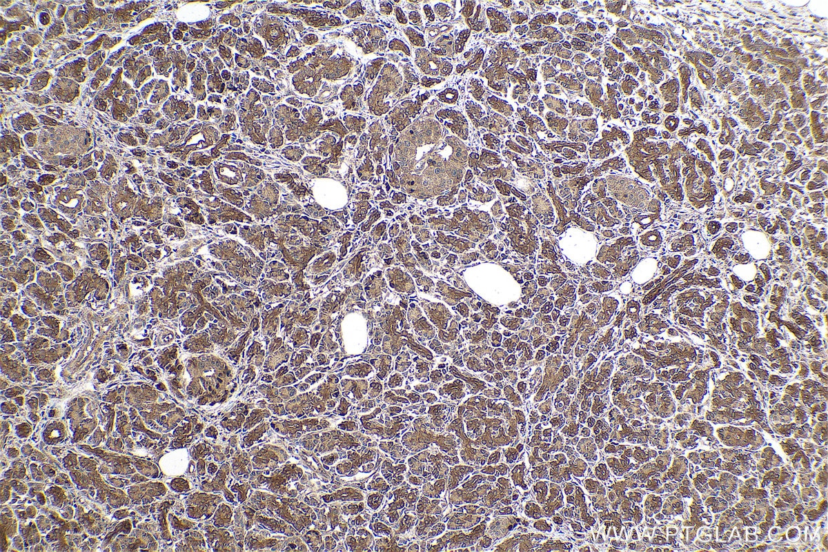 Immunohistochemical analysis of paraffin-embedded human pancreas cancer tissue slide using KHC0775 (FERMT1/Kindlin 1 IHC Kit).