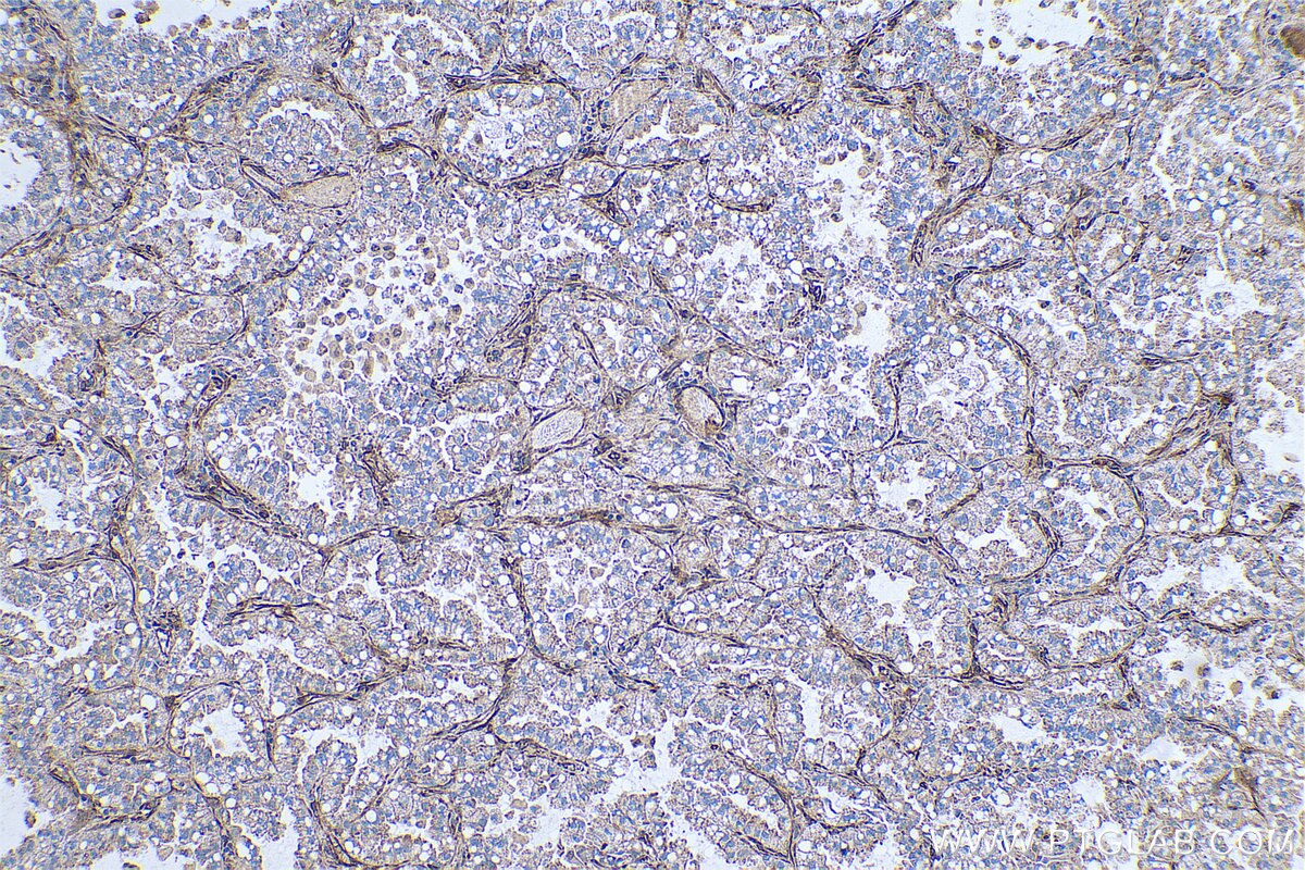 Immunohistochemical analysis of paraffin-embedded human lung cancer tissue slide using KHC0688 (FERMT2/Kindlin 2 IHC Kit).