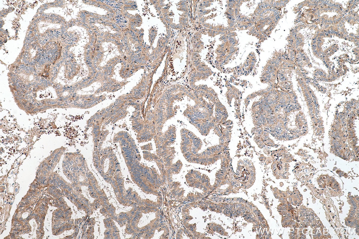 Immunohistochemical analysis of paraffin-embedded human ovary tumor tissue slide using KHC0688 (FERMT2/Kindlin 2 IHC Kit).