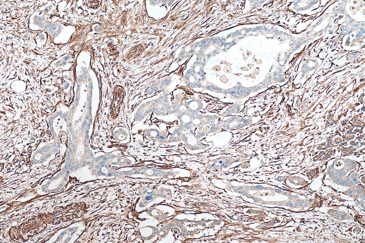 Immunohistochemical analysis of paraffin-embedded human pancreas cancer tissue slide using KHC0688 (FERMT2/Kindlin 2 IHC Kit).