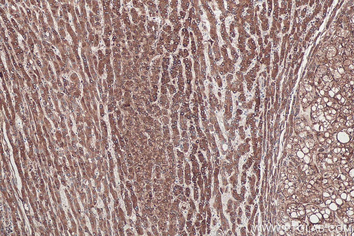 Immunohistochemical analysis of paraffin-embedded human liver cancer tissue slide using KHC0388 (Fibrinogen Beta Chain IHC Kit).