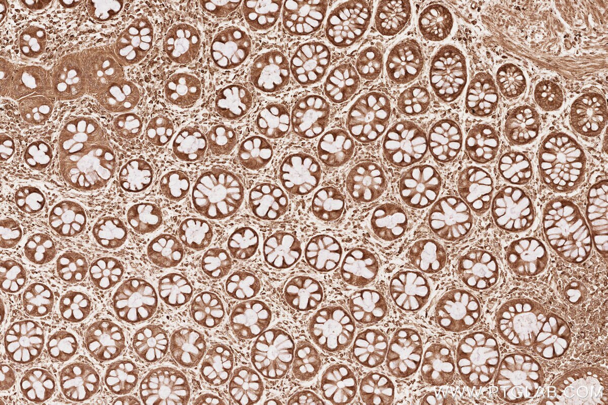 Immunohistochemical analysis of paraffin-embedded human rectal cancer tissue slide using KHC2545 (FGD3 IHC Kit).