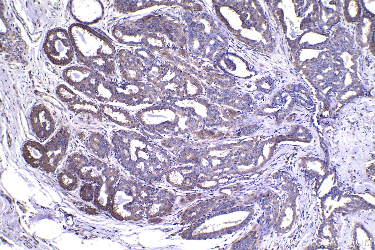 Immunohistochemical analysis of paraffin-embedded human breast cancer tissue slide using KHC1508 (FGF1 IHC Kit).