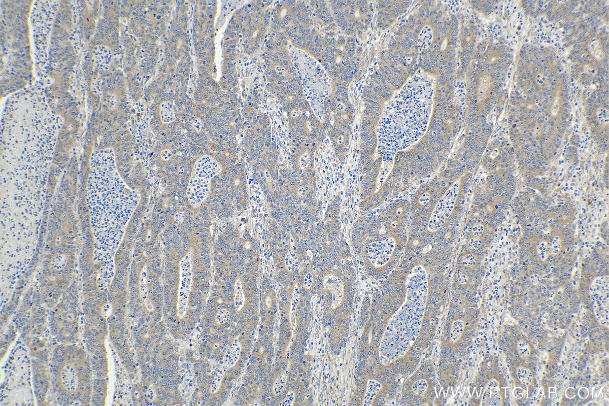 Immunohistochemical analysis of paraffin-embedded human colon cancer tissue slide using KHC1508 (FGF1 IHC Kit).
