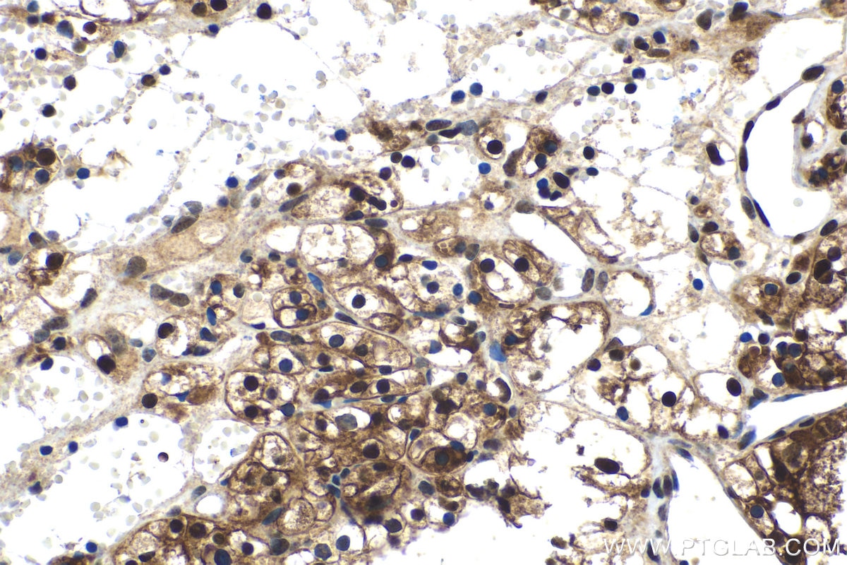 Immunohistochemical analysis of paraffin-embedded human renal cell carcinoma tissue slide using KHC1516 (FGF2 IHC Kit).