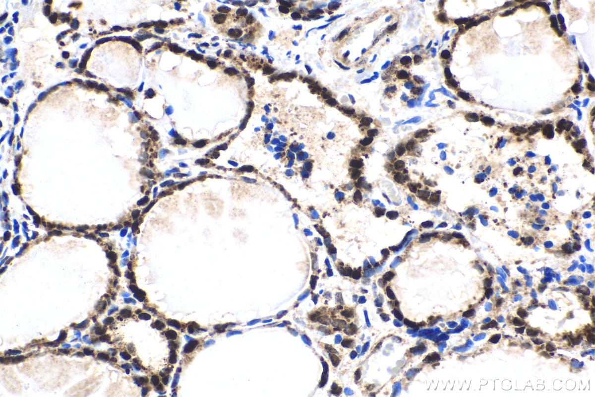 Immunohistochemical analysis of paraffin-embedded human thyroid cancer tissue slide using KHC1516 (FGF2 IHC Kit).