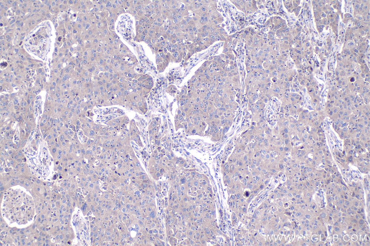 Immunohistochemical analysis of paraffin-embedded human lung cancer tissue slide using KHC1056 (FGFR3 IHC Kit).