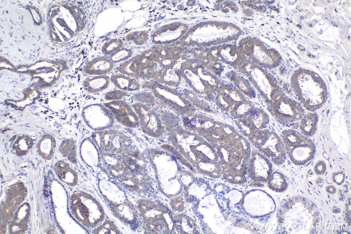 Immunohistochemical analysis of paraffin-embedded human breast cancer tissue slide using KHC1056 (FGFR3 IHC Kit).