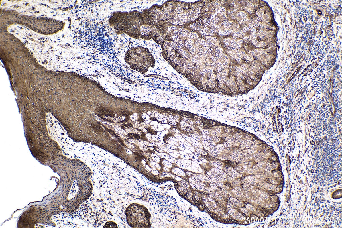 Immunohistochemical analysis of paraffin-embedded human skin cancer tissue slide using KHC1727 (FHL2 IHC Kit).