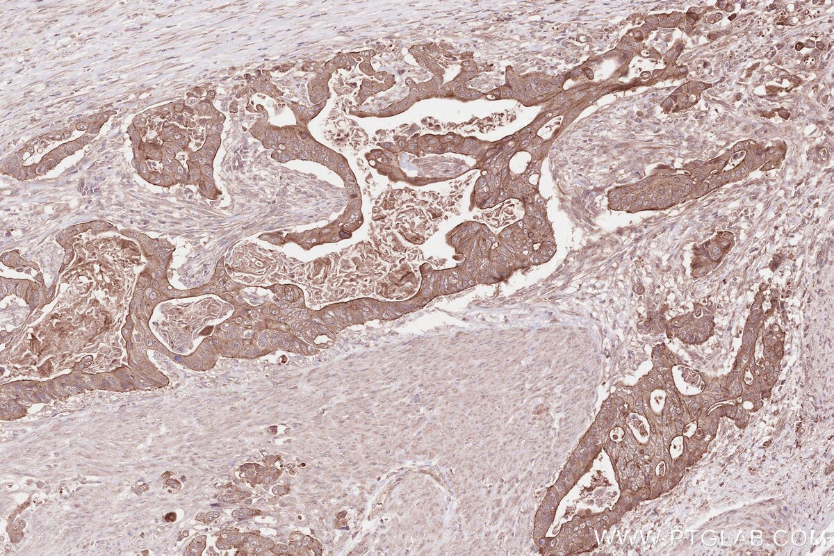 Immunohistochemical analysis of paraffin-embedded human stomach cancer tissue slide using KHC2591 (FIGNL1 IHC Kit).