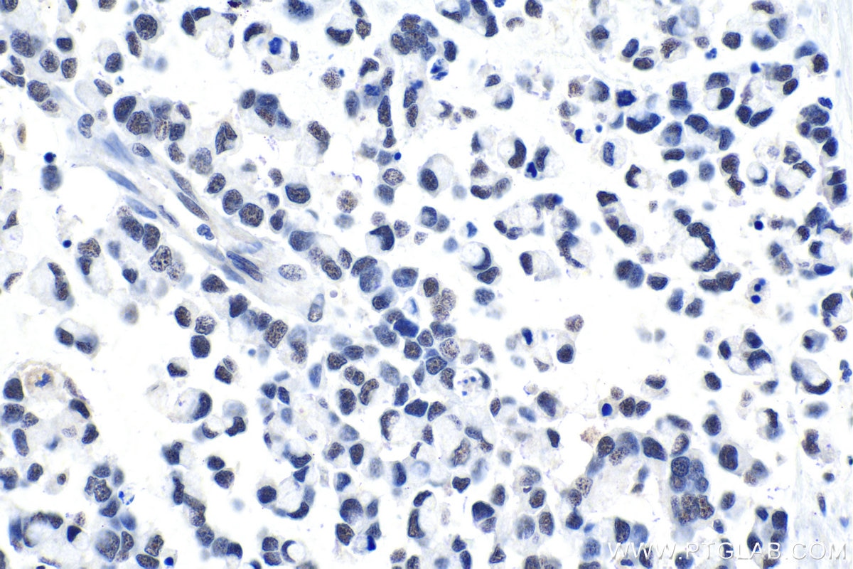 Immunohistochemical analysis of paraffin-embedded human colon cancer tissue slide using KHC1018 (FIP1L1 IHC Kit).