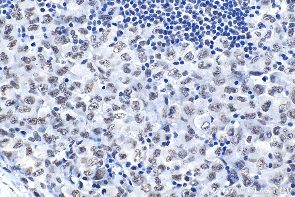 Immunohistochemical analysis of paraffin-embedded human lymphoma tissue slide using KHC1018 (FIP1L1 IHC Kit).