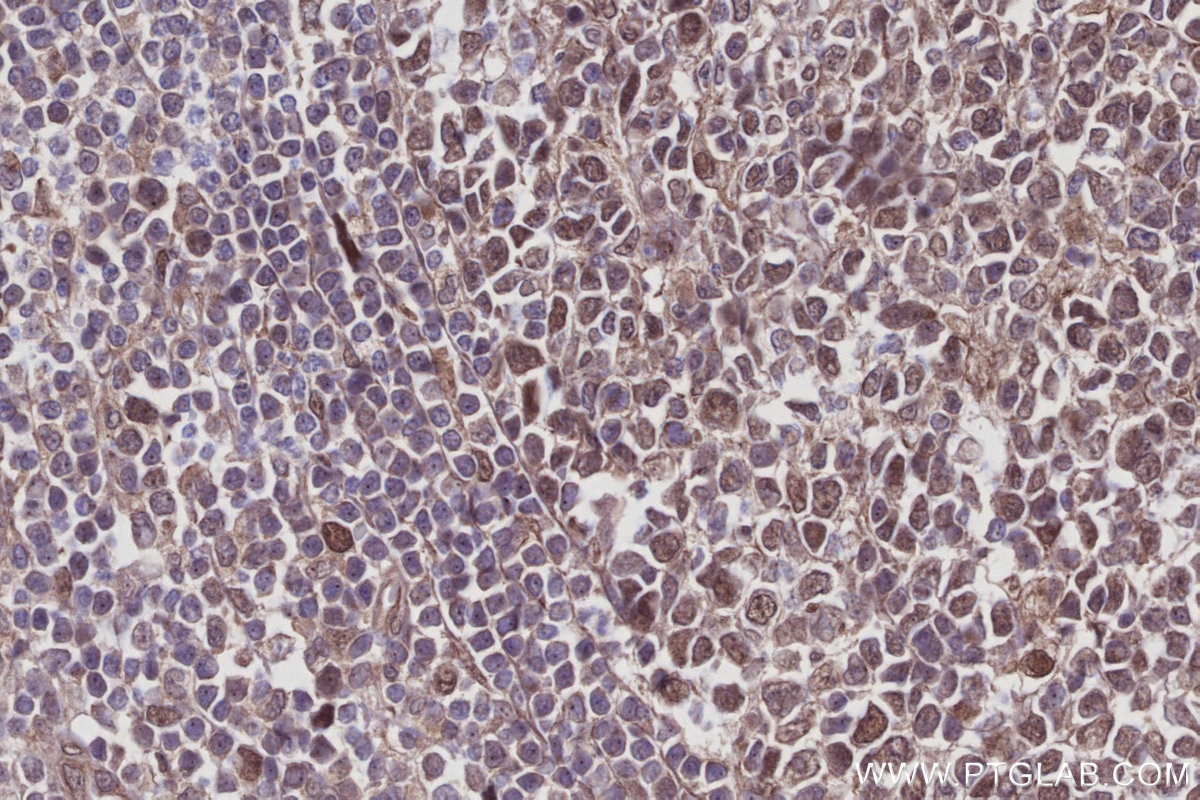 Immunohistochemical analysis of paraffin-embedded human appendicitis tissue slide using KHC2952 (FIRRM/C1orf112 IHC Kit). Immunohistochemical analysis of paraffin-embedded human appendicitis tissue slide using KHC2952 (FIRRM/C1orf112 IHC Kit).