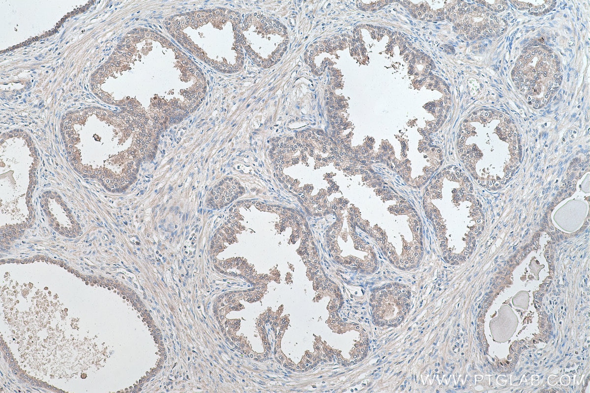 Immunohistochemical analysis of paraffin-embedded human prostate cancer tissue slide using KHC0417 (FKBP4/FKBP52 IHC Kit).