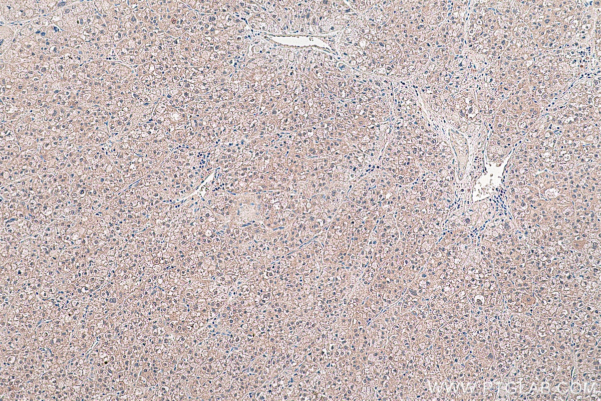 Immunohistochemical analysis of paraffin-embedded human liver cancer tissue slide using KHC0417 (FKBP4/FKBP52 IHC Kit).