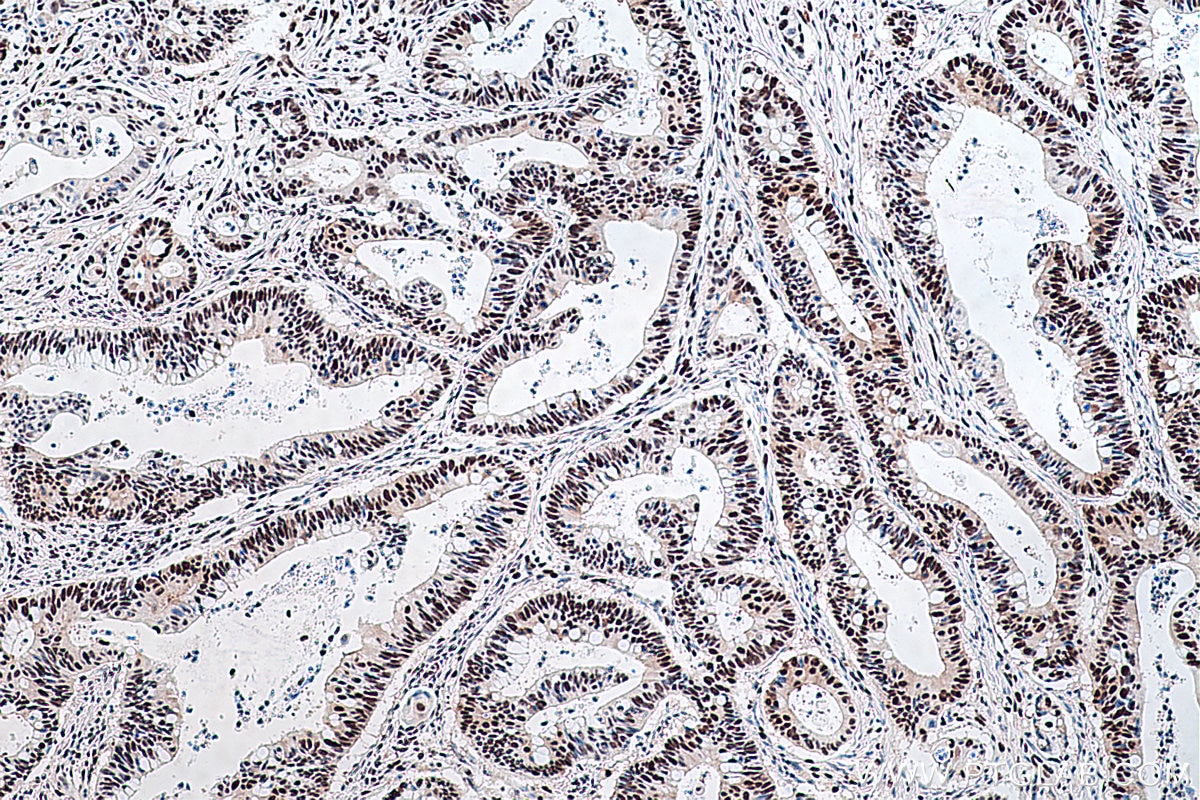 Immunohistochemical analysis of paraffin-embedded human colon cancer tissue slide using KHC0418 (FKBP5 IHC Kit).